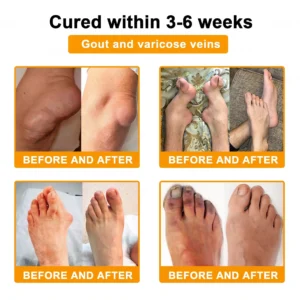 30% Discount🎁🎁|𝐌𝐔𝐑𝐖𝐎𝐍® Bee Venom Pain-Relief Bone Healing Cream ✨✨✨(Specially for older adults)