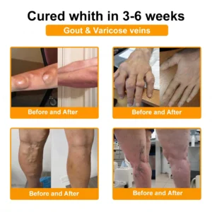 30% Discount🎁🎁|𝐌𝐔𝐑𝐖𝐎𝐍® Bee Venom Pain-Relief Bone Healing Cream ✨✨✨(Specially for older adults)