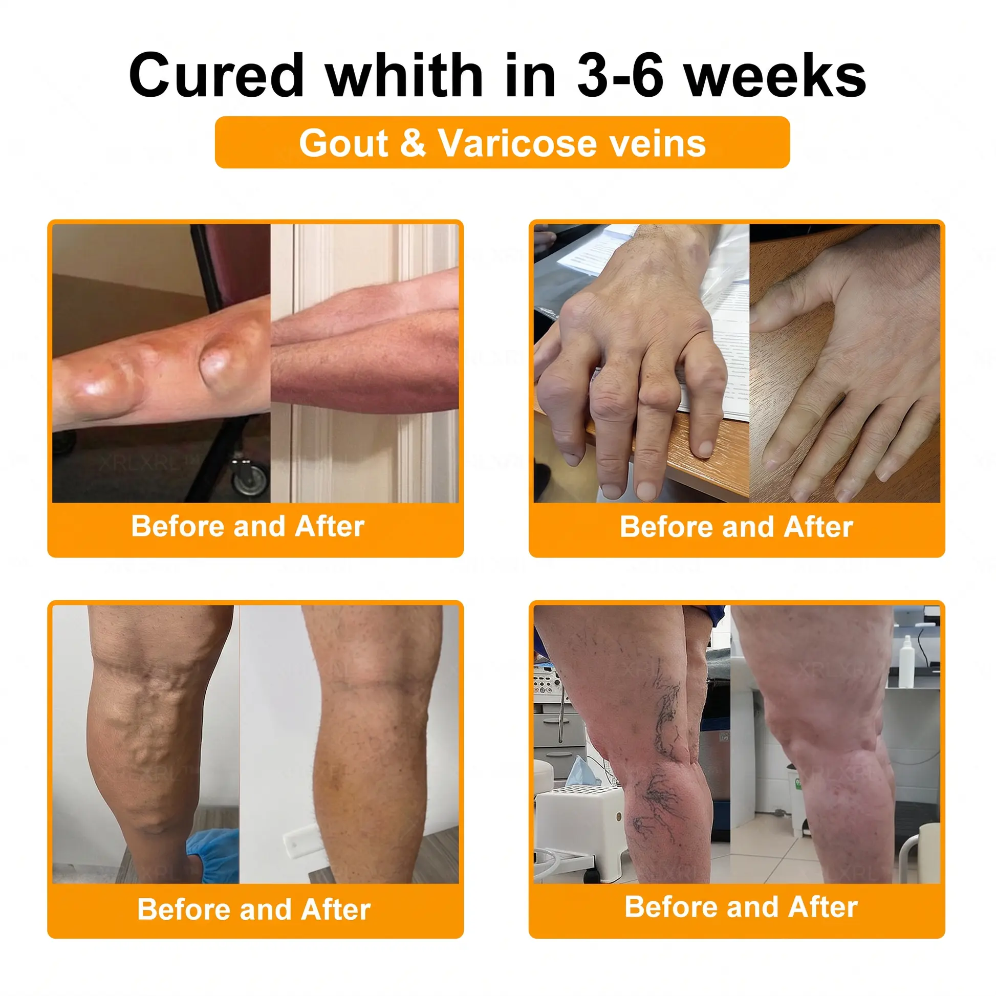 30% Discount🎁🎁|𝐌𝐔𝐑𝐖𝐎𝐍® Bee Venom Pain-Relief Bone Healing Cream ✨✨✨(Specially for older adults)