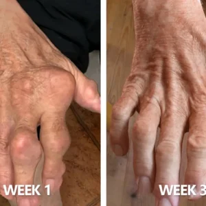 30% Discount🎁🎁|𝐌𝐔𝐑𝐖𝐎𝐍® Bee Venom Pain-Relief Bone Healing Cream ✨✨✨(Specially for older adults)
